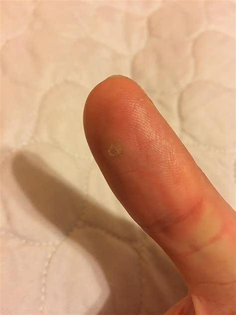 Is this a wart? Best treatment options? : r/Warts