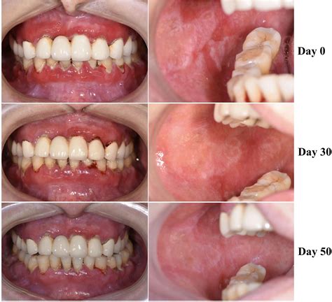 Frontiers | Case Report: Mucous Membrane Pemphigoid With IgG and IgA