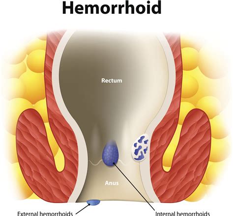 Internal Hemorrhoids Treatment | Dr. Zuri Murrell
