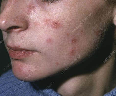Discoid lupus erythematosus - Stock Image - C052/2481 - Science Photo ...