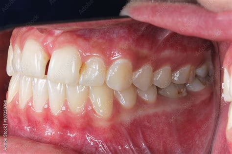 gebiss zaehne seitlich  stock foto adobe stock