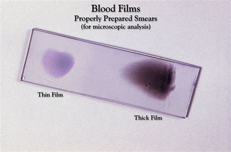 Blood film - wikidoc