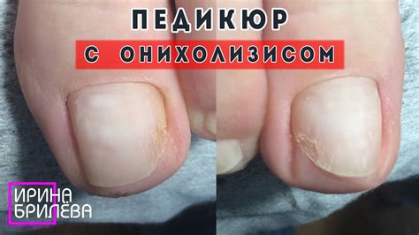 ПЕДИКЮР и Онихолизис 🆘 Отслоения и Пустота под ногтем - YouTube