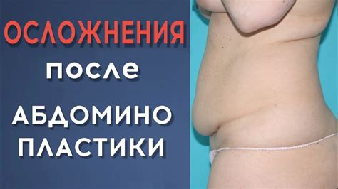 Осложнения после абдоминопластики: чем опасна операция? - YouTube