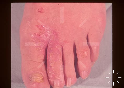 DermaCompass - Tinea pedis