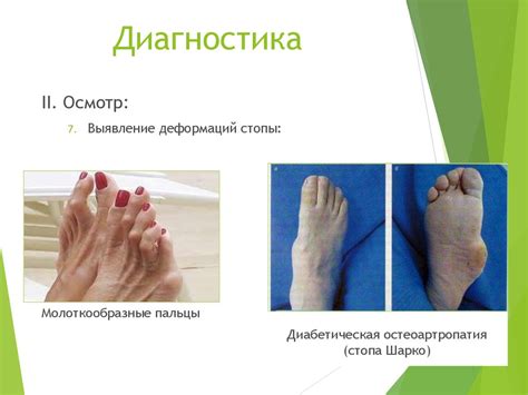 Диабетическая полинейропатия - презентация онлайн