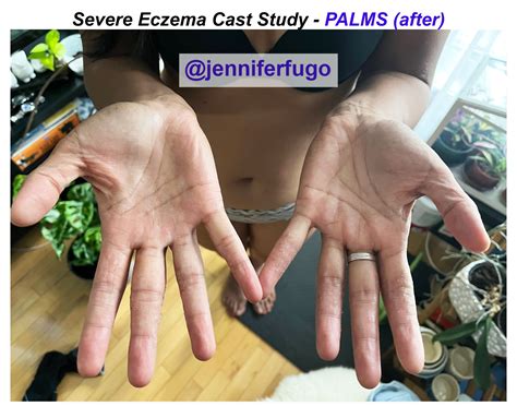 328: Client Case Study: Severe Eczema On Feet + Body