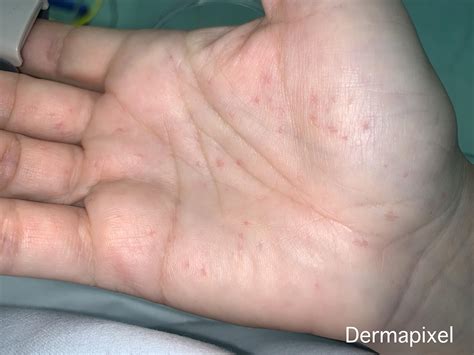 Dermapixel: Puntitos rojos en las manos y bultos por todo el cuerpo