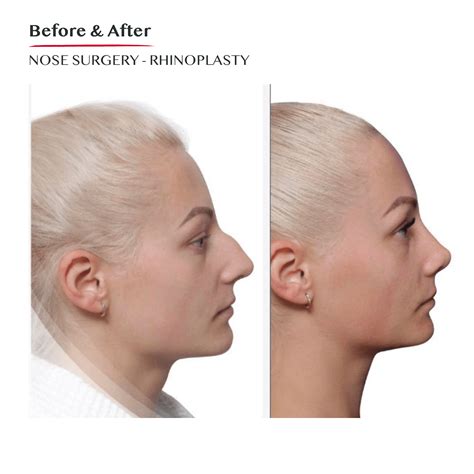 nose surgery rhinoplasty cosmetic surgery dublin ireland nose job