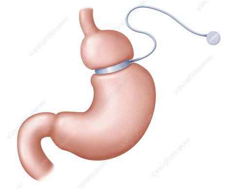 gastric band stock image  science photo library