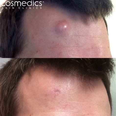 Neck Cyst Removal Surgery