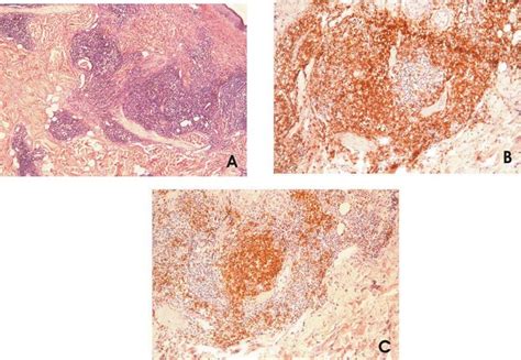 A) Section through the tumour showing that the infiltrate was present ...