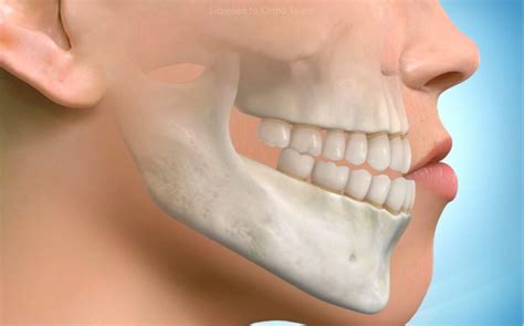 koreksi protrusi bimaxillary  empat ekstraksi premolar pertama