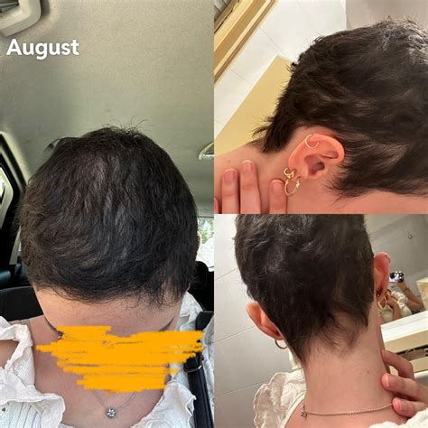 Doctor said my hair loss is getting better on its own. What do you guys