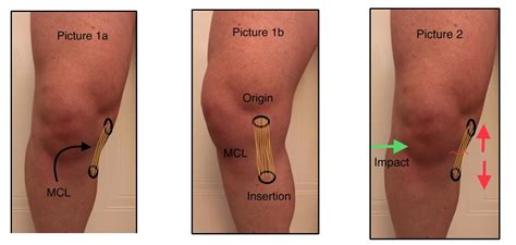 Physiotherapy spotlight: Knee MCL tears/ sprains | All For One
