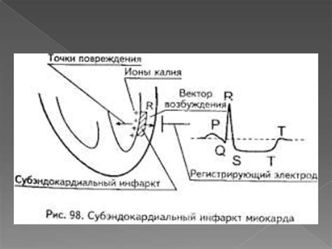 Миокард инфаркті ЭКГ белгілері - презентация онлайн