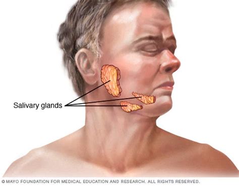 Cáncer Cabeza y Cuello | Cáncer de glándulas salivales | Cirugía Oncológica