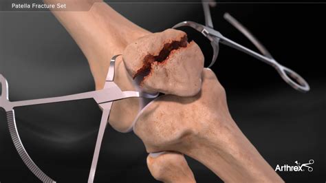 Arthrex - Patella Fracture