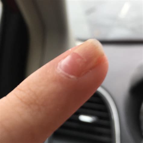 Some of my pinky nail came off the bed a couple weeks ago after an