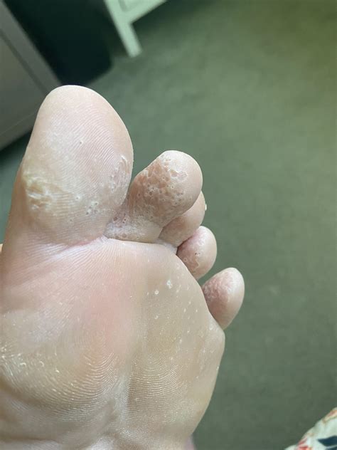 Could this be Pitted Keratolysis?! : r/medical