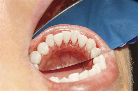 plaque heart  teeth  lisa mccoy blog