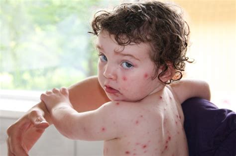 The 6 Most Common Skin Rash Types - HealthVibe