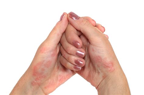 Kontakt Dermatit | Dermatologiya