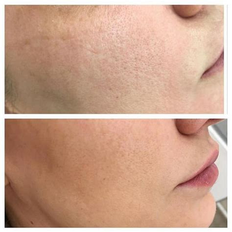Мезоботокс - Mesobotox