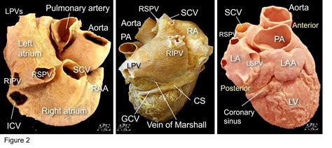 gross epicardial topography   atriums cardiac anatomy