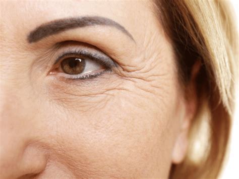 11 Effective Under-Eye Wrinkle Treatments | Aestha Clinic