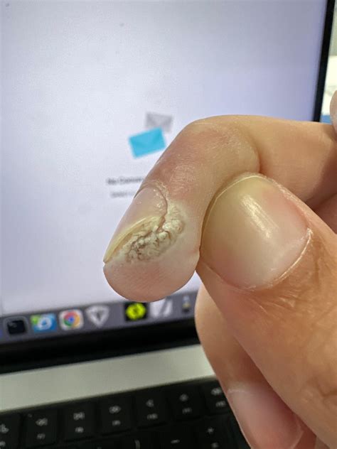 Finger Wart : r/Warts