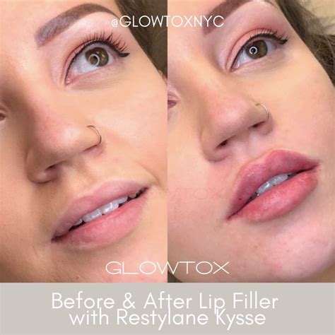 Natural Looking Lip Filler Before & After | Lip fillers, Lip ...