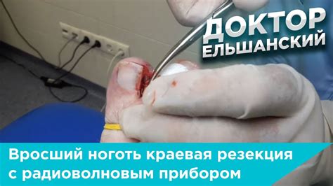 Вросший ноготь краевая резекция с применением радиоволнового прибора ...
