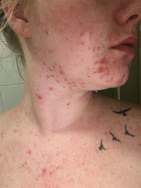Cystic acne on chin during second trimester-HELP!