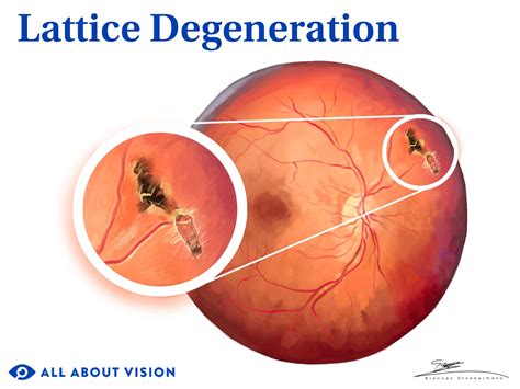 Lattice Degeneration: Risks, Treatment and Symptoms