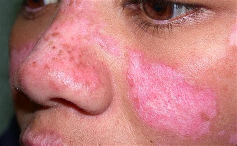 Discoid Lupus Erythematosus