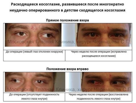 Фотографии пациентов до и после операции по исправлению косоглазия ...