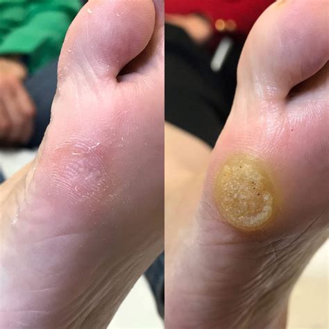 Heaton Podiatry - Treatments