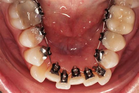 Lingual Technique - MUNICH ORTHODONTICS - Dr. Franca von Dörnberg