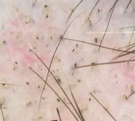 trichoscopy   alopecia areata plaque presenting black points