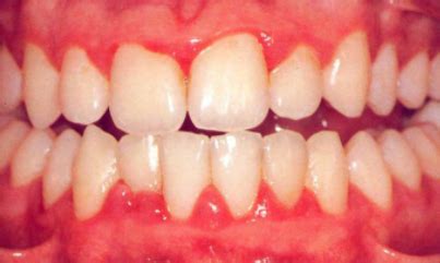 gingival description Flashcards | Quizlet