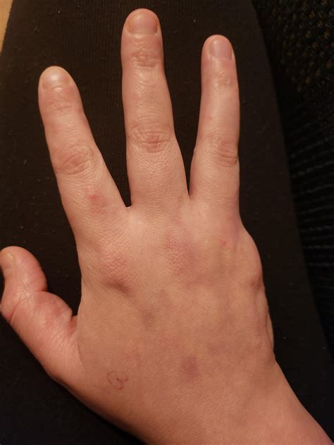 I had a surgery called a ray resection to have my pinky finger removed