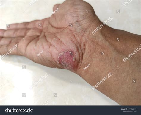 kurap means ringworm  attacks human stock photo