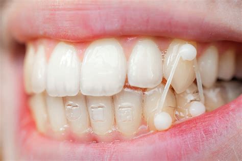 purpose  orthodontic elastics ligatures image