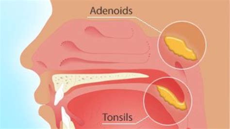 Adenoiditis: Causes And Complications - Ask The Nurse Expert