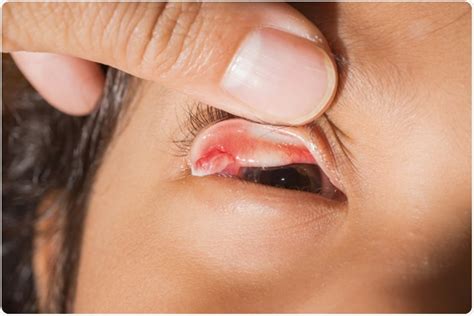 symptoms  pyogenic granuloma