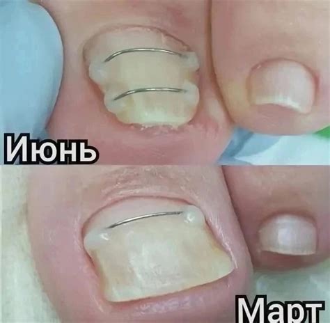 10 ПРИЧИН, ПОЧЕМУ «ТИТАНОВАЯ НИТЬ» ЛУЧШЕ УДАЛЕНИЯ ВРОСШЕГО НОГТЯ Вот ...