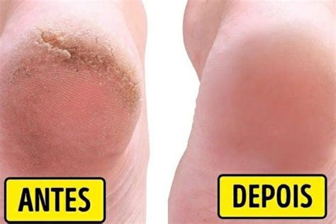 O Que É Bom Para Pés Rachados - Dica para pés rachados e ressecados ficarem lisinhos e macios