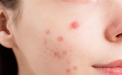 pimples  acne  types  treatment