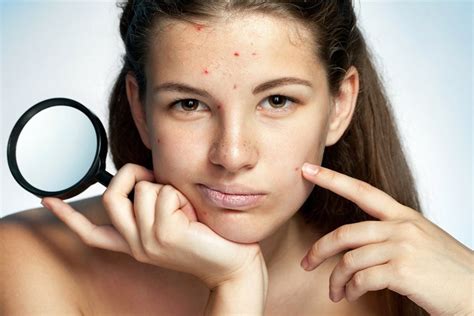 10 самых эффективных средств от прыщей - Дерматология и венерология ...